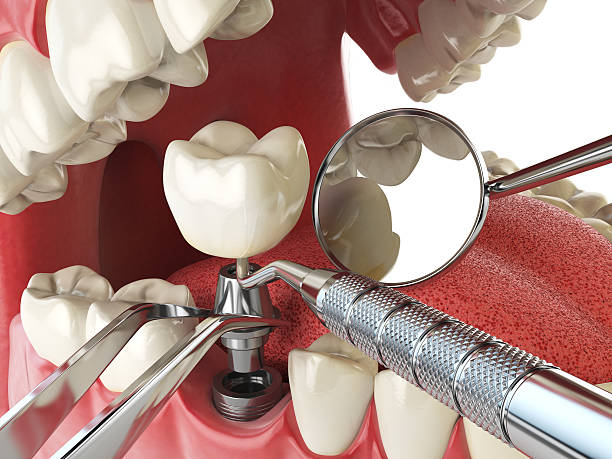 Best Emergency Dental Care for Broken or Chipped Teeth in Commerce, GA